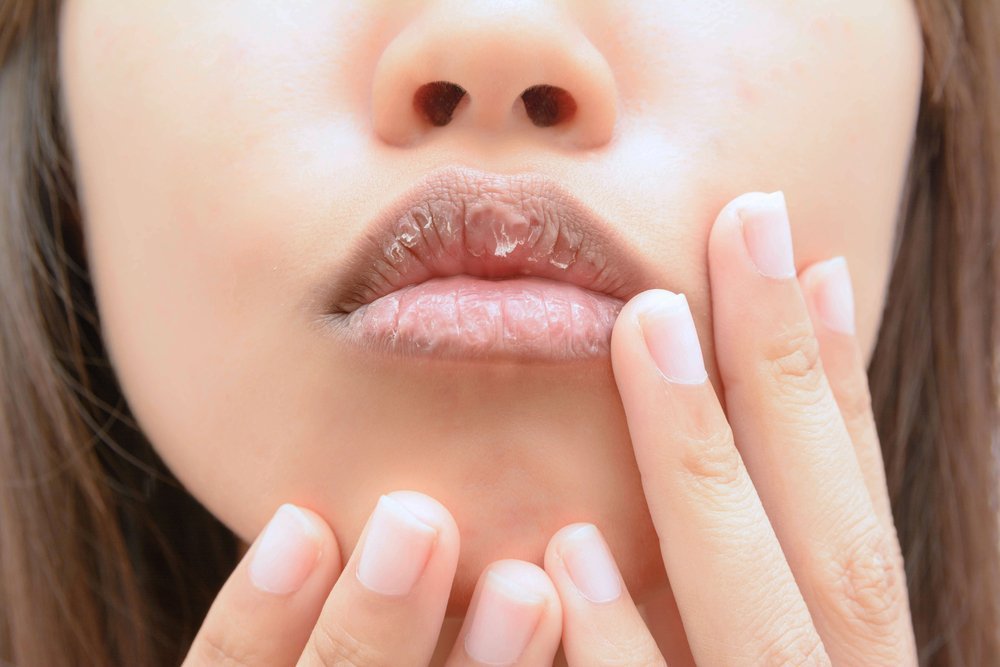 Основные причины, по которым трескаются губы, и как избавиться от этой проблемы